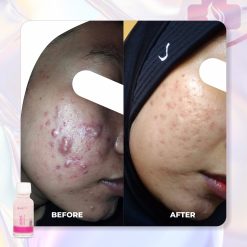 Alternative view of ACNE LOTION