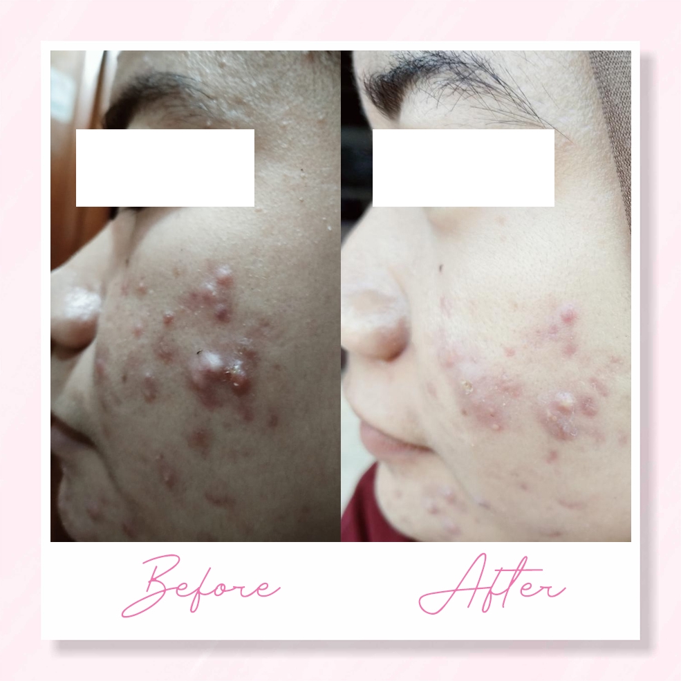 ACNE GEL TREATMENT - Gambar 2