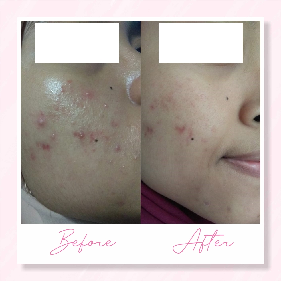 ACNE GEL TREATMENT - Gambar 5
