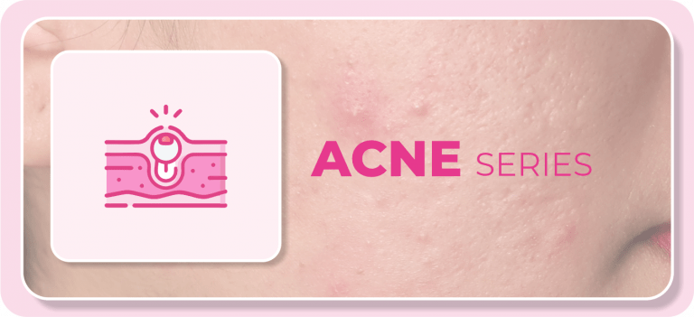 ⋆ ACNE SERIES ⋆