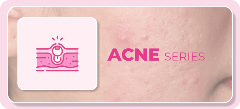 ⋆ ACNE SERIES ⋆